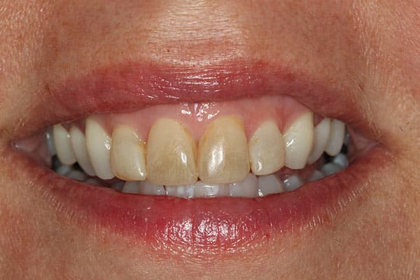 Before complete dentures