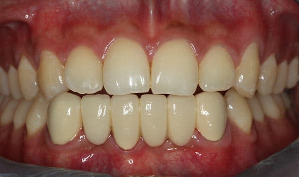 After complete dentures