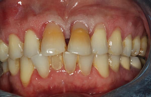 Before complete dentures