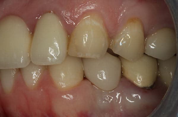 After complete dentures